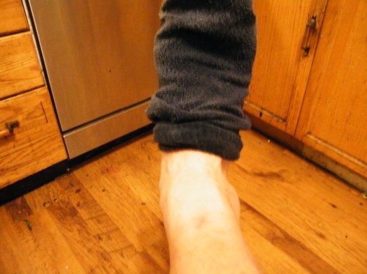 Swollen ankle after coming home from x-rays.